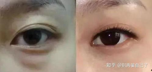 内吸眼袋视频,高效除眼袋新方法深度解析